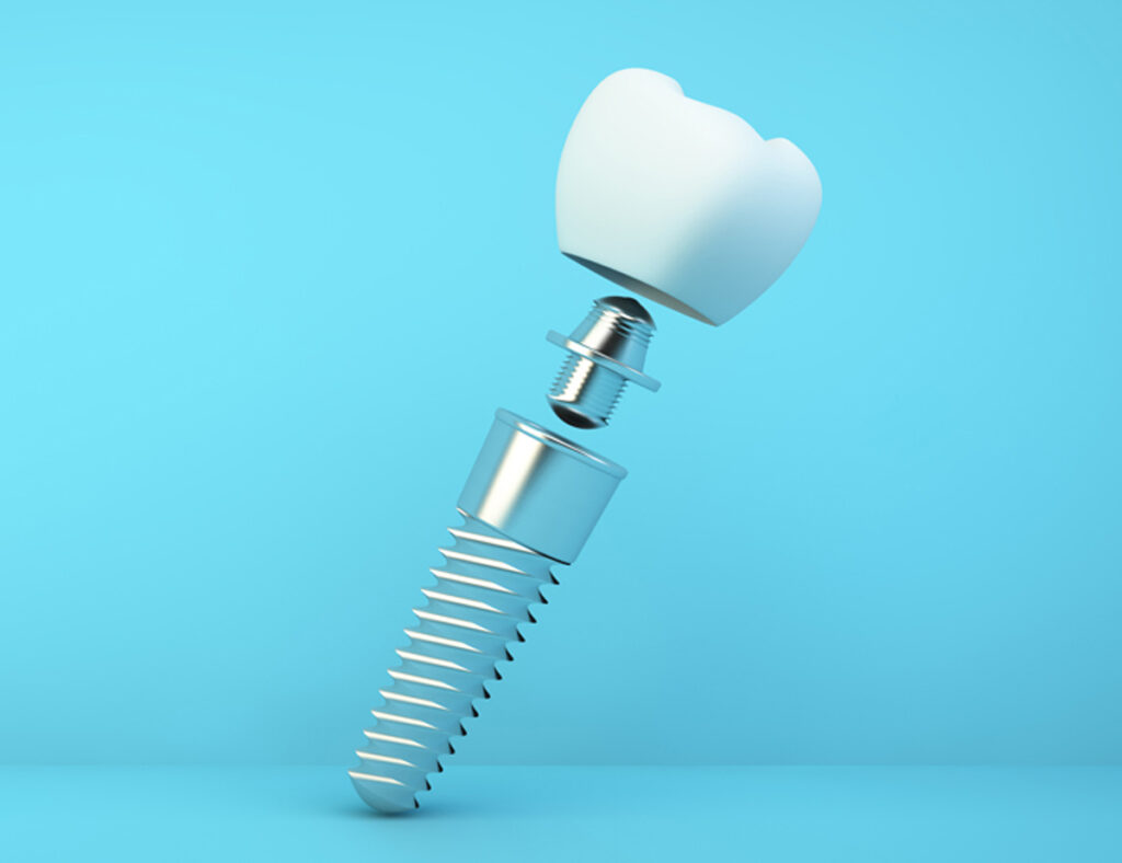 Planting Dental Implants - The Process